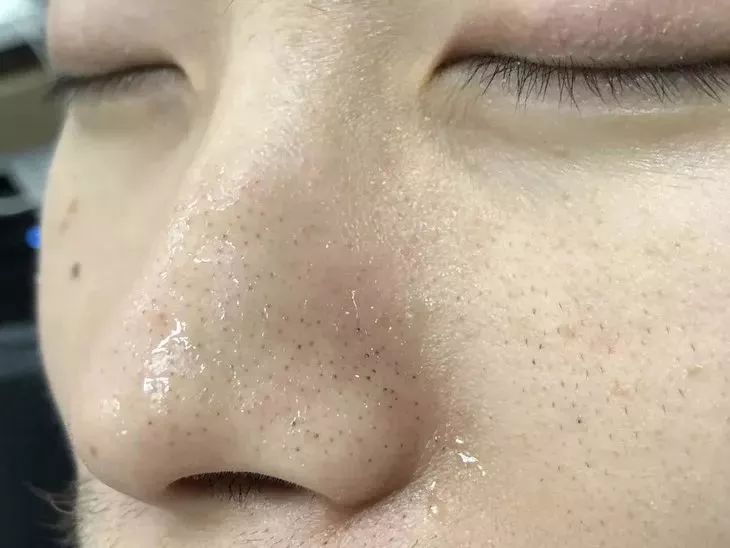 又爽又恶心的去黑头方法来了！5分钟将你10年的黑头白头连根拔起！