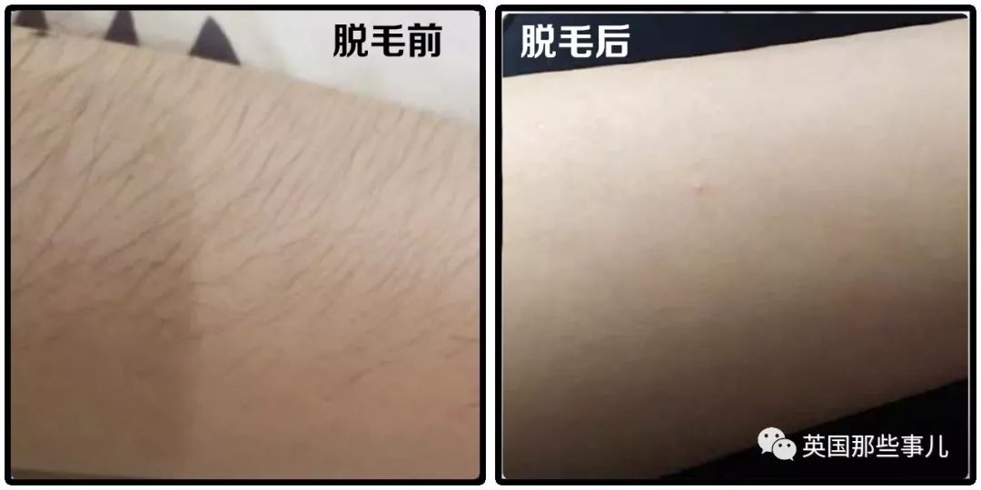 人类进化过程中体毛变少了,人类体毛为什么变少了