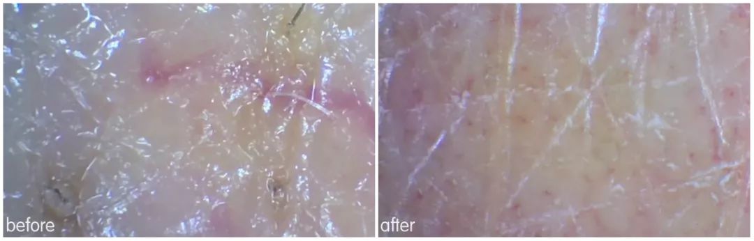 灏忚寕鑲岃瘖瀹よˉ姘村悧,灏忚寕鑲岃瘖瀹ゅ埌搴曟湁澶氬己