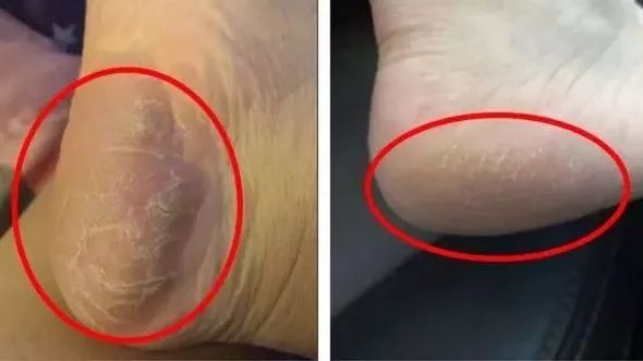 脚后跟套上这个“*钟金**罩”夏季穿鞋嫩到反光！干裂、老茧、死皮都没了！