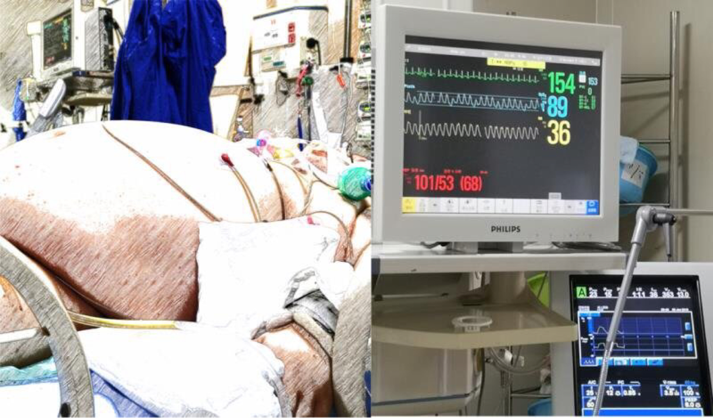 体重340斤,血脂高到仪器爆表!压塌CT机,瑞金医护团队成功救治重症急性胰腺炎患者