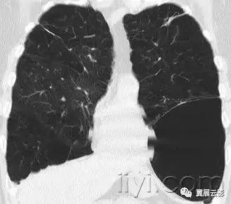 胸部解剖及常见疾病影像表现,胸部影像学基础知识