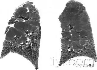胸部解剖及常见疾病影像表现,胸部影像学基础知识