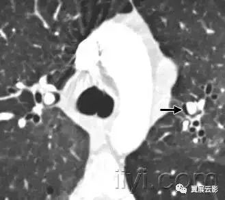 胸部解剖及常见疾病影像表现,胸部影像学基础知识