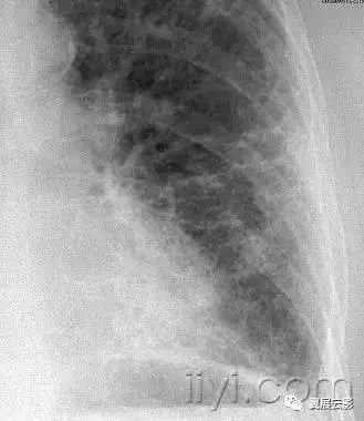 胸部解剖及常见疾病影像表现,胸部影像学基础知识