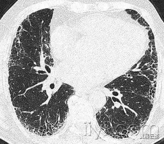 胸部解剖及常见疾病影像表现,胸部影像学基础知识