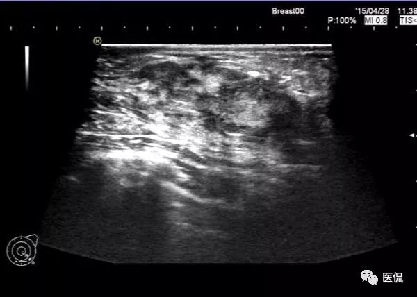 先天性乳头凹陷，MRI发现炎性病变，怎么诊断？