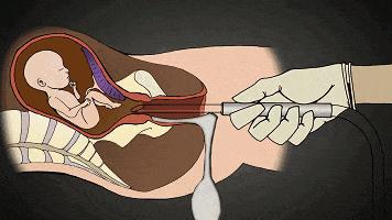 可视人流和无痛人流的区别,人流无痛好还是普通人流好