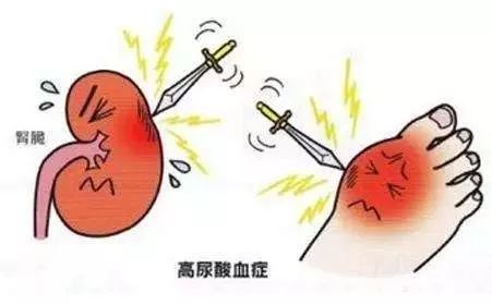 【有肾说甚】第8期｜大量饮水可缩短痛风发作时间……原来还有这些方法可治疗高尿酸血症