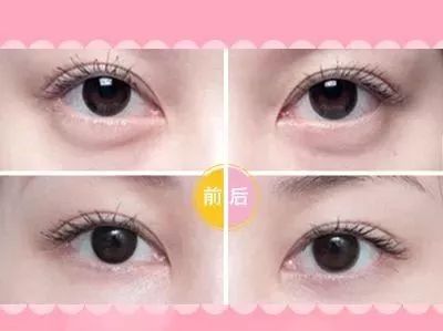 眼袋掉下去了,眼袋要掉地上了的图片