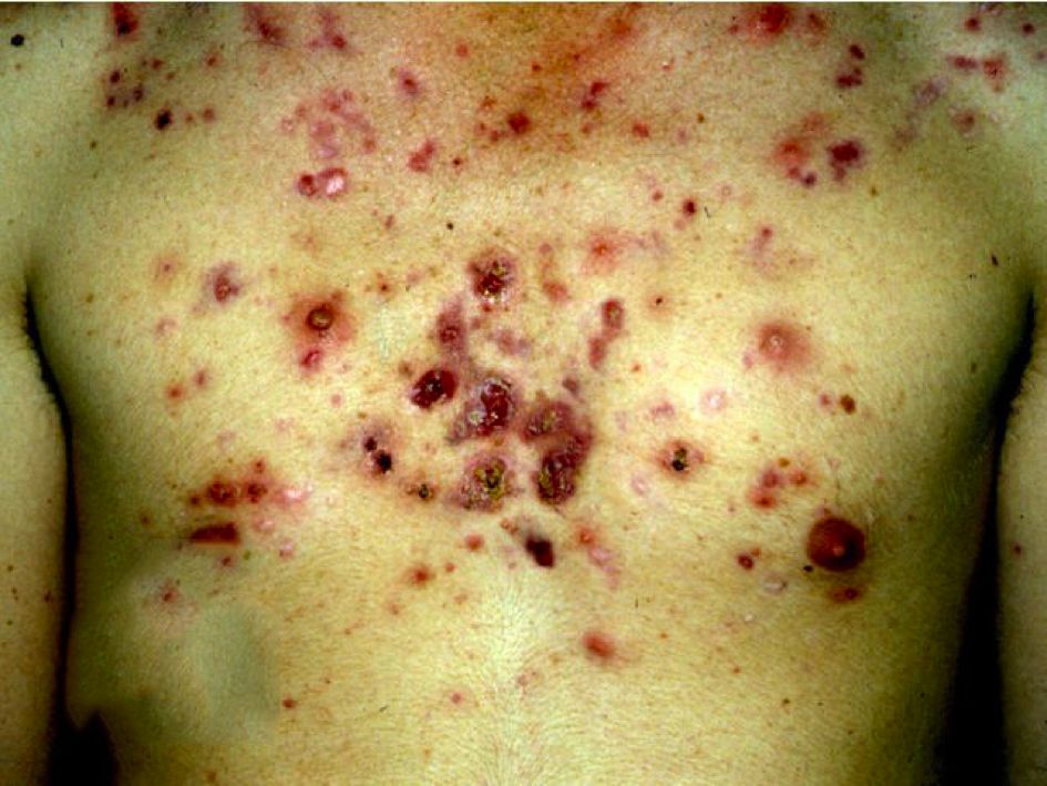 哪种皮肤病容易被误判为银屑病,容易被误诊为疥疮的皮肤病