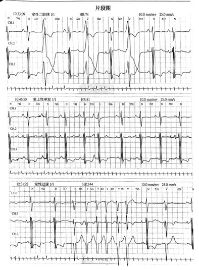 心衰反复住院怎么办,心衰双下肢反复浮肿有什么好办法