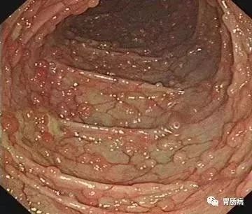 所有的息肉都会变成癌吗,什么样子的息肉容易癌变