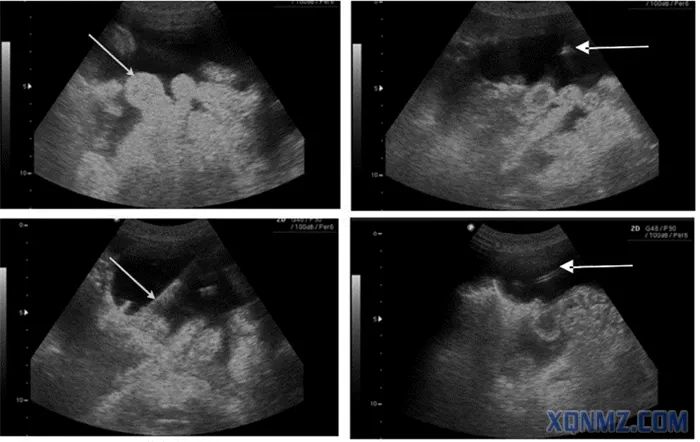 超声应用之穿刺定位