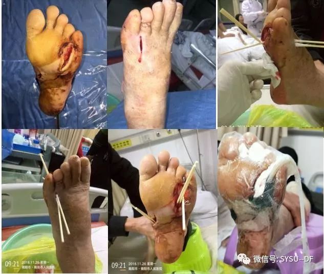 负压吸引糖尿病足的应用,负压滴灌治疗糖尿病足优势是什么