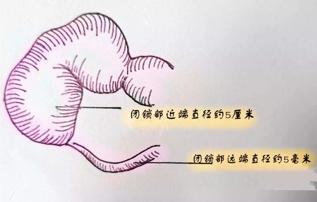 初生婴儿肠扩张,宝宝在妈妈肚子里快生出来了