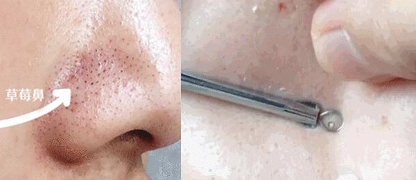 为什么能从鼻头上挤出白色的东西,鼻子挤出来的白丝是什么