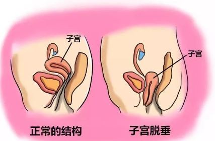产后ella自曝后遗症,ella自曝产后
