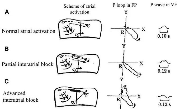 交替变化的P波，揭露房间传导的秘密｜识“图”寻踪