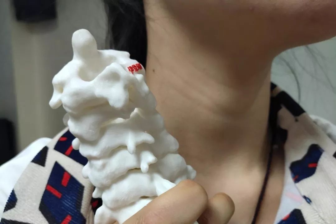 全球首例！西安3D打印人体颈椎术解决世界难题