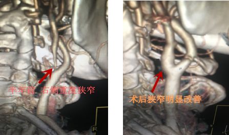 做了这个手术，肖大爷的白发变黑了……