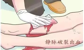 静脉曲张科普视频,关于下肢静脉曲张你知道多少