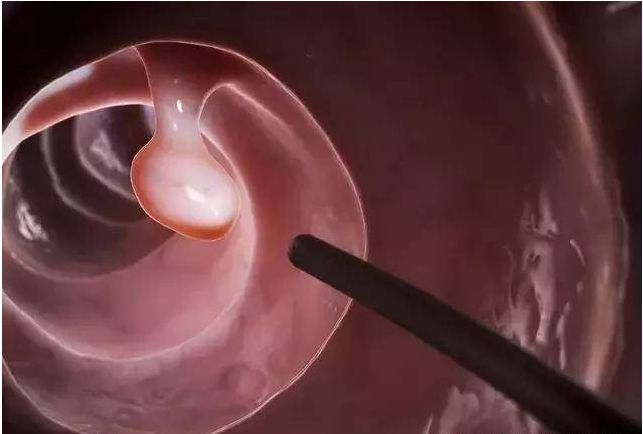 放屁太多确诊肠癌,女子总是放屁患上肠癌晚期