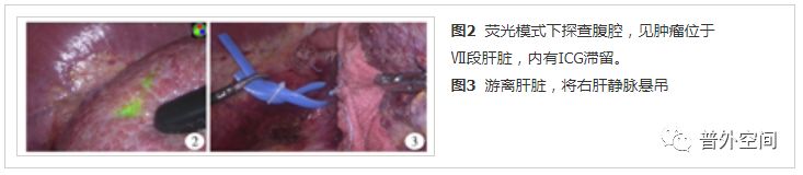 吲哚菁绿荧光引导腹腔镜解剖性肝脏Ⅶ段切除手术流程