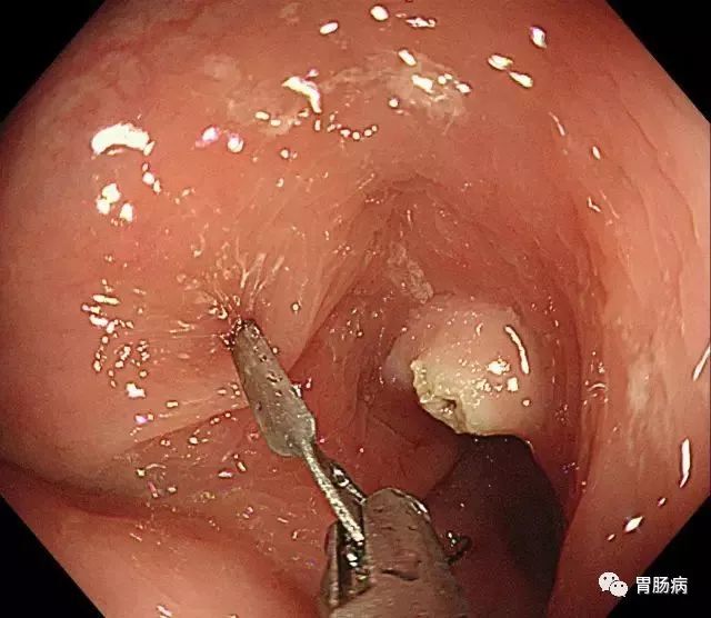 结肠息肉切除术术前准备,结肠镜下息肉冷切除术