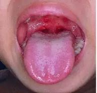 手足口病疫苗是预防终身吗,ev71手足口病疫苗潮州哪里有得打