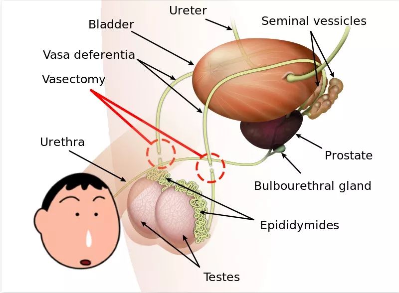 JNCI：男默女泪！215万男性随访38年发现，输精管结扎与前列腺癌风险增加15%有关丨科学大发现
