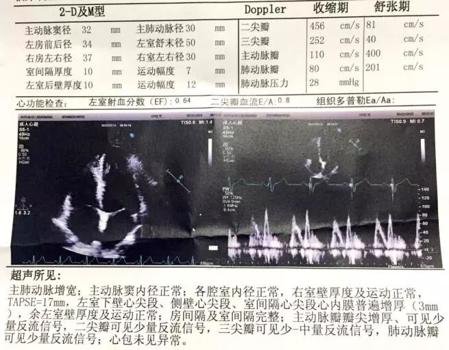 亚急性心内膜炎有蛋白尿吗,loeffler心内膜炎发病概率