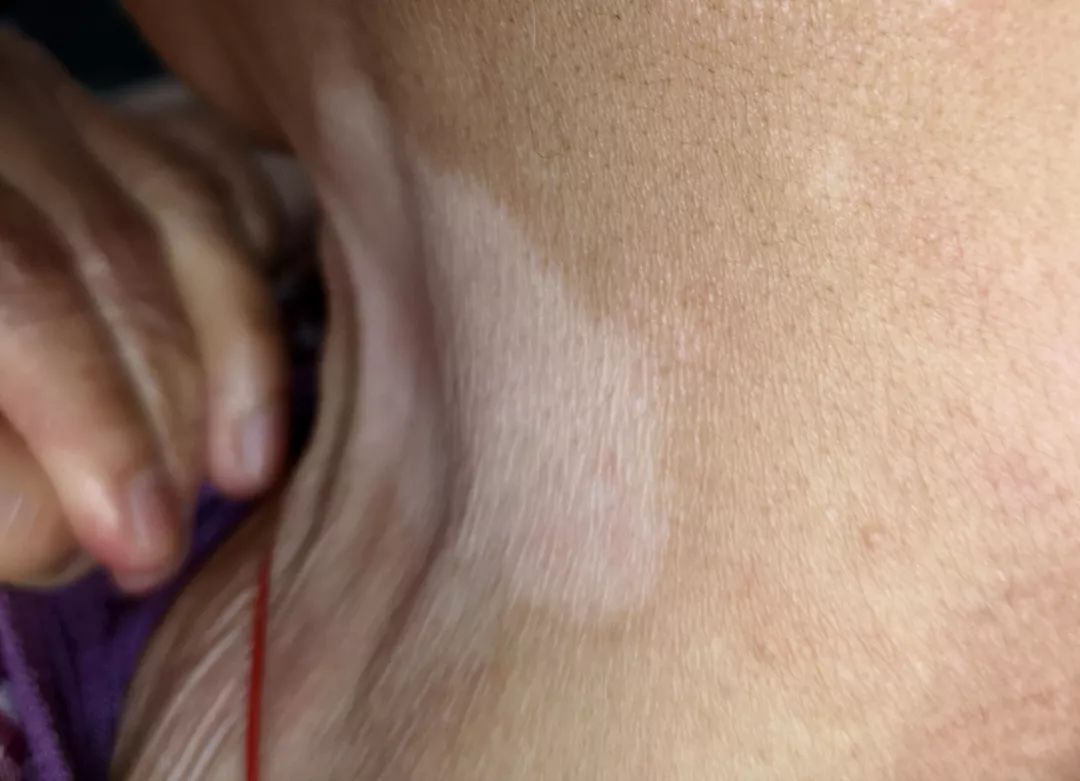 白色花斑糠疹,白色糠疹需要与哪些疾病相鉴别