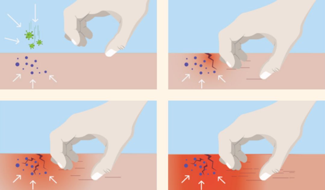 痒？给你一支“不求人”