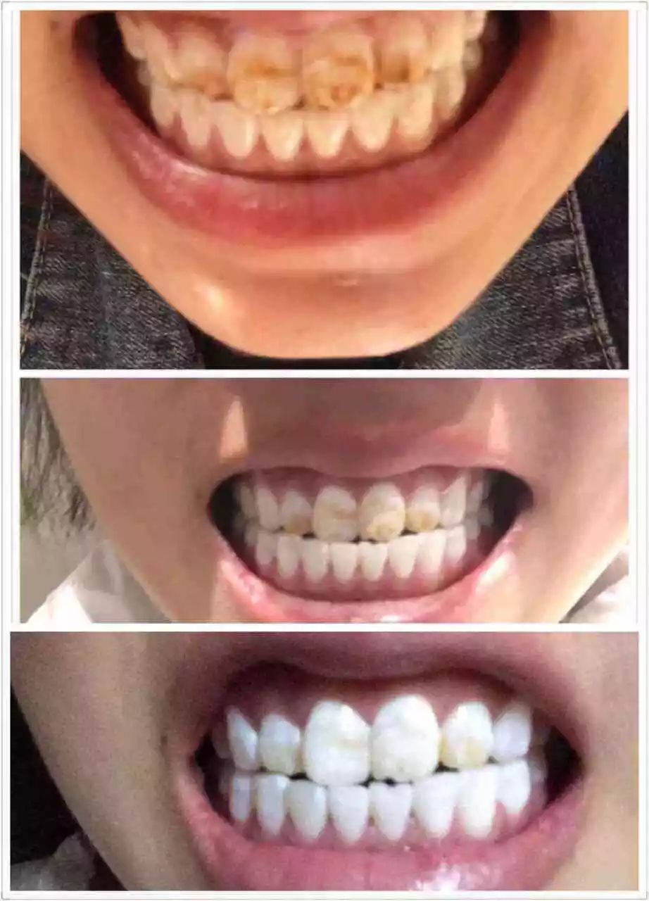 牙黄口臭用什么牙膏最有效贴吧,去牙黄口臭的牙膏最有效