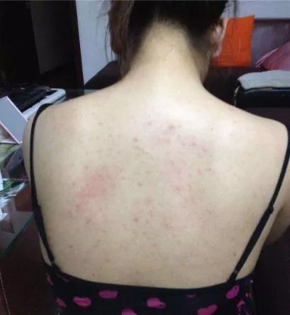 鸡皮肤永久消除,37天快速祛鸡皮肤