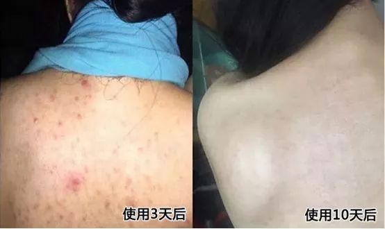 鸡皮肤怎么穿露背装,短期内快速去除鸡皮肤