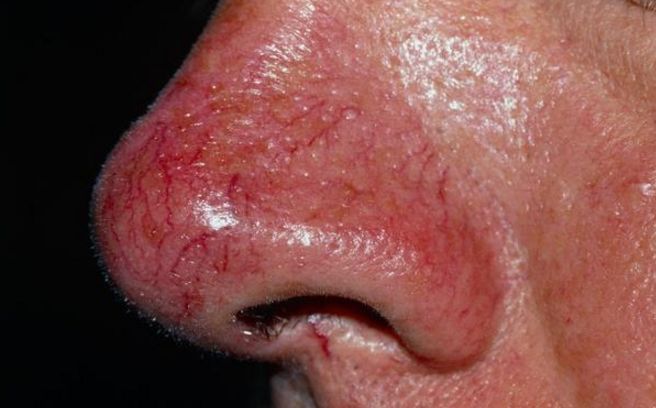 脸上的红血丝怎么处理,脸上的红血丝怎么解决