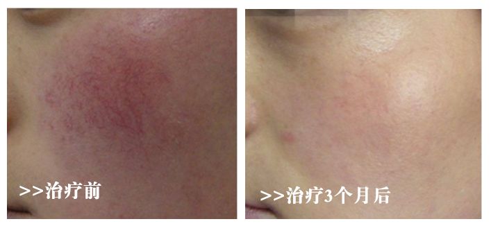 脸上的红血丝怎么处理,脸上的红血丝怎么解决