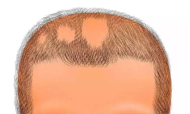 头顶秃一块到底是斑秃还是鬼剃头,斑秃和鬼剃头是一种病吗怎么治