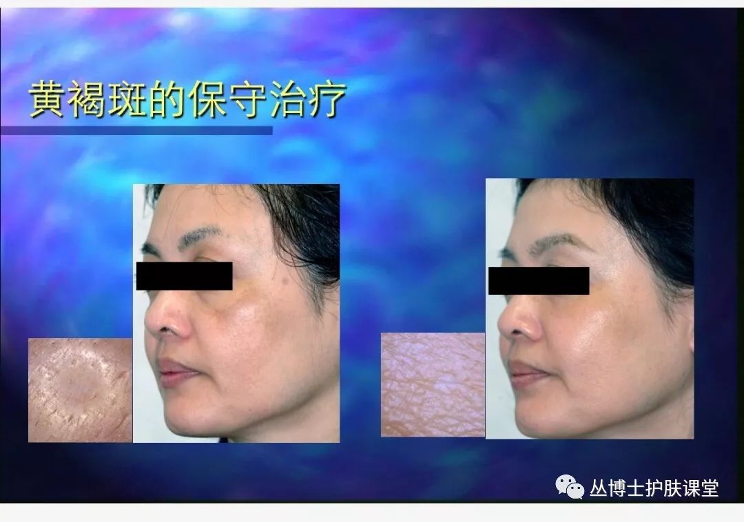 治疗褐斑病的偏方,褐斑病怎样才叫治愈好