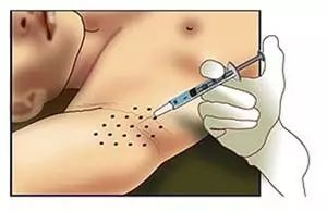 去除腋臭绝招,这几种方法让腋臭远离你