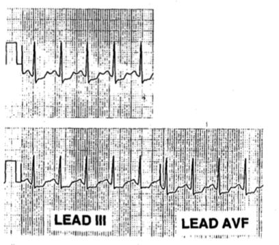 st段呈异常动态变化,st段动态改变提示什么