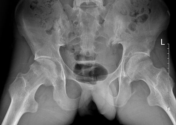 骨道堂治疗强直性脊柱炎效果,御医堂治疗强直性脊柱炎