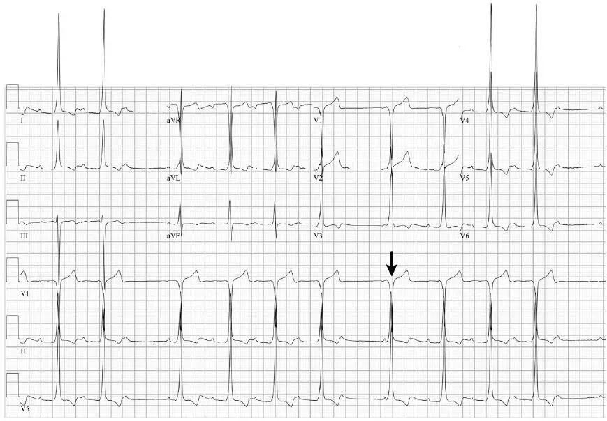 预激房颤,房颤没症状需要射频消融吗