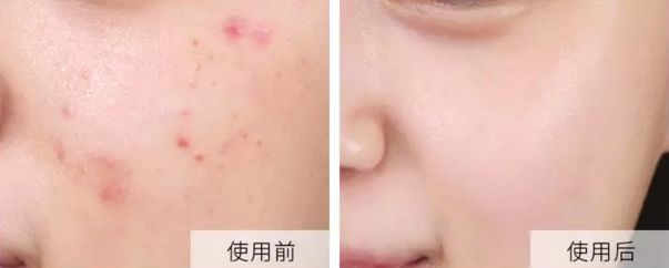 断货王祛痘胶囊,秒杀祛痘化妆品一元