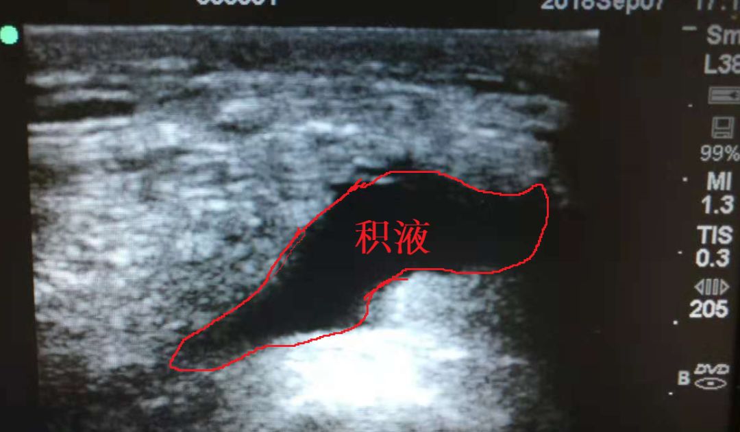 膝盖急性损伤肿过大腿，这样处理后她第二天竟好了八成