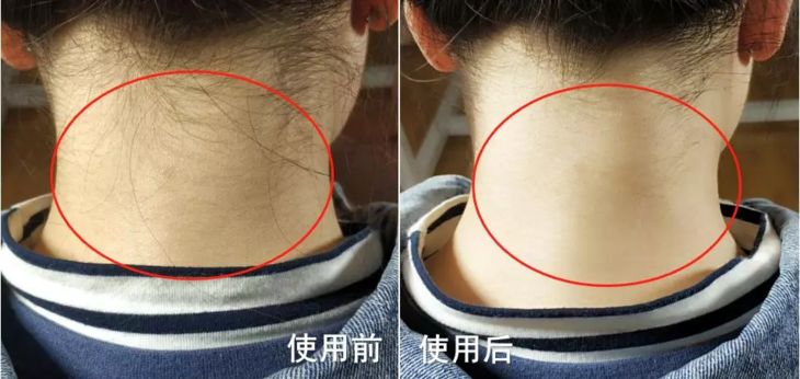 治疗肩颈痛的神器,好的缓解肩颈疼痛产品