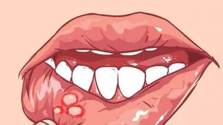 口腔溃疡的痛，是吃火锅都感受不到幸福……