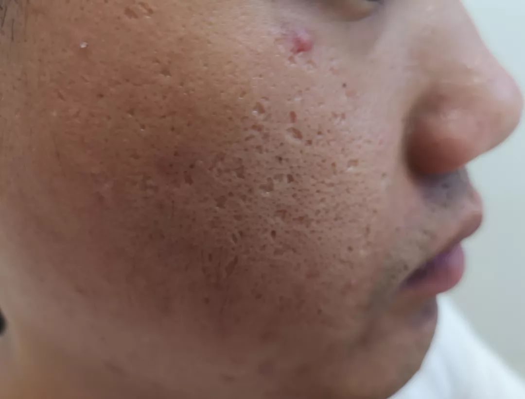 治痘痘和痘印痘坑哪个药膏好,脸上有痘痘痘印痘坑怎么去修复